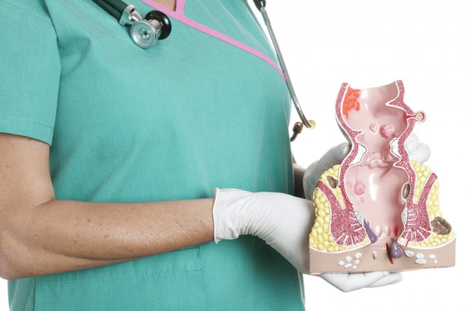 Doctorul demonstrează modelul hemoroid