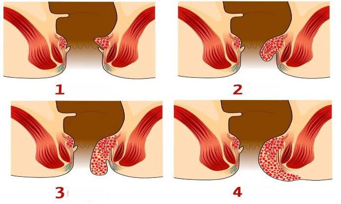cum arată hemoroizii în diferite stadii