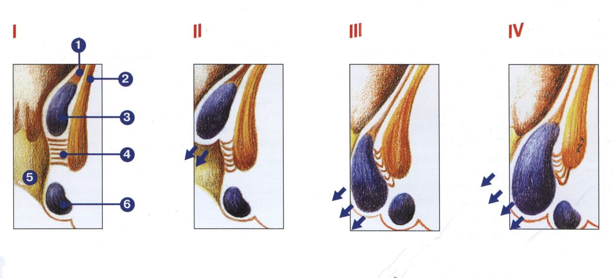 stadiile dezvoltării hemoroizilor